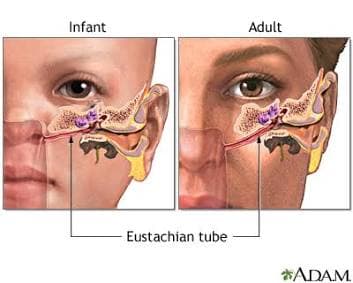 Child vs. Adult Ear Anatomy and Fluid Buildup. Source: MedlinePlus