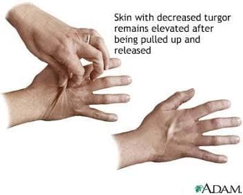 The Skin Turgor (Pinch) Test for Dehydration Severity. Source: MedlinePlus